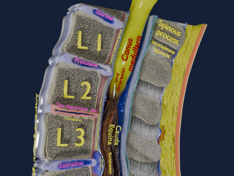 Intervertebral herniation slipped ruptured disc 3D 모델
