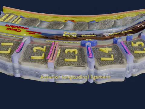 Intervertebral herniation slipped ruptured disc 3D 모델
