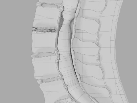 Intervertebral herniation slipped ruptured disc 3D Model