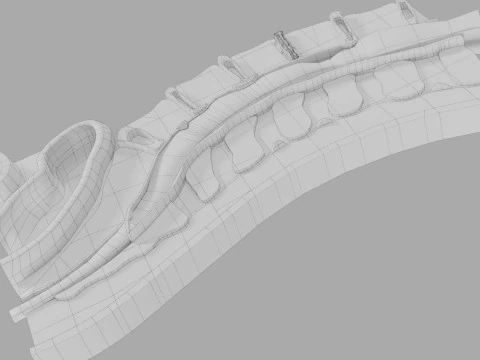 Intervertebral herniation slipped ruptured disc 3D Model
