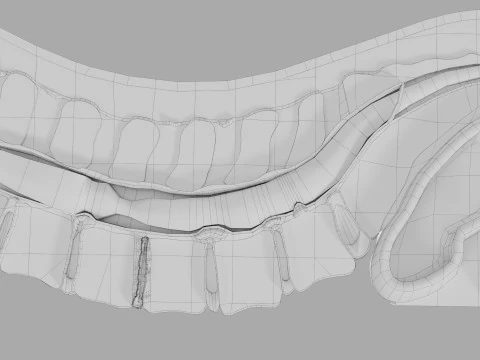 Intervertebral herniation slipped ruptured disc 3D Model
