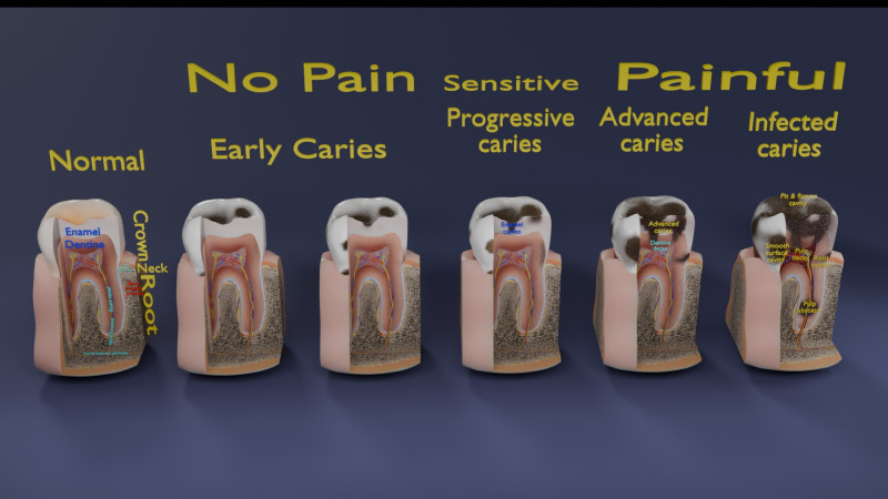 Caries Teeth severity schematic cut sectional 3D Модель .c4d .max .obj .3ds .fbx .stl .blend