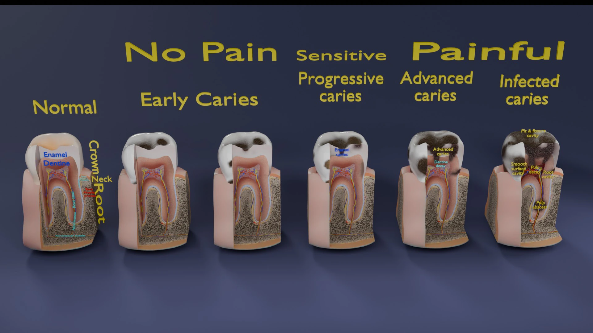 Caries Teeth severity schematic cut sectional 3D Model .c4d .max .obj .3ds .fbx .stl .blend 