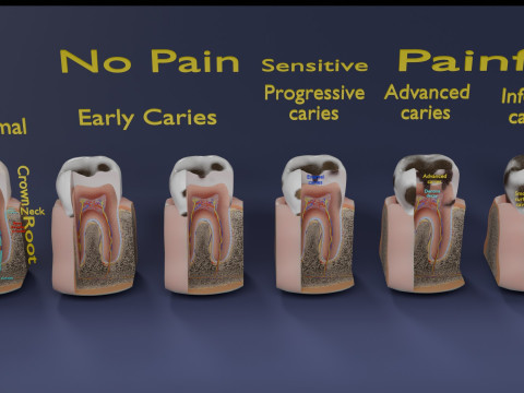 Caries Teeth severity schematic cut sectional 3D Модель