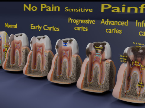 Caries Teeth severity schematic cut sectional 3Dモデル
