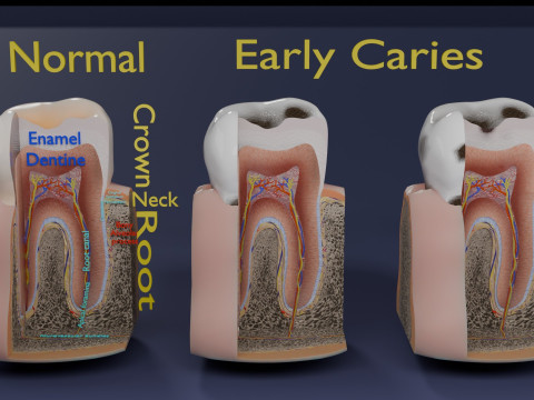 Caries Teeth severity schematic cut sectional 3Dモデル