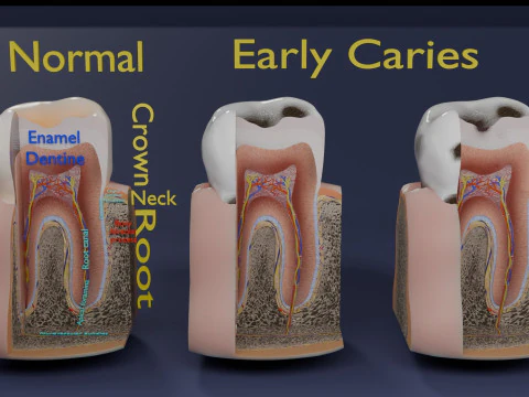 Caries Teeth severity schematic cut sectional 3D Model