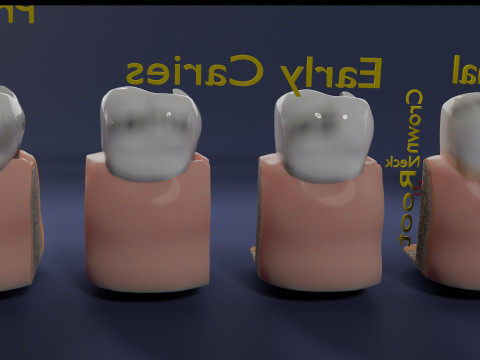 Caries Teeth severity schematic cut sectional 3Dモデル