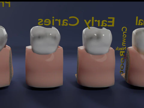 Caries Teeth severity schematic cut sectional 3D Model