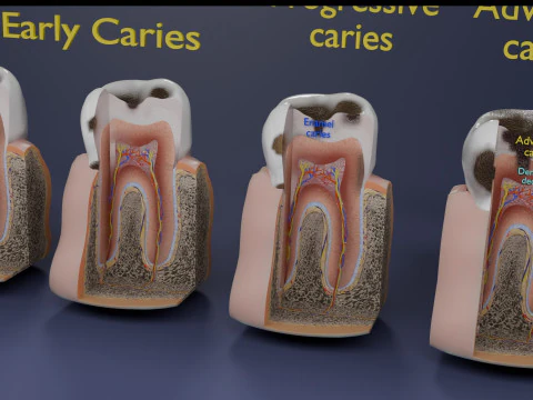 Caries Teeth severity schematic cut sectional 3D Model
