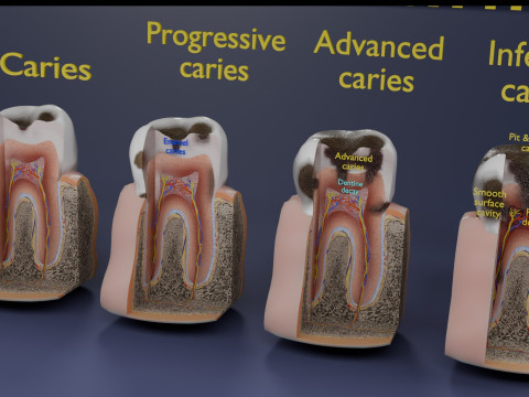 Caries Teeth severity schematic cut sectional 3Dモデル