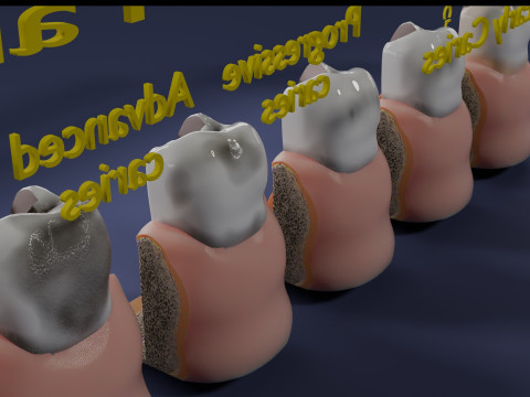 Caries Teeth severity schematic cut sectional 3Dモデル