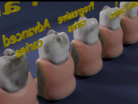 Caries Teeth severity schematic cut sectional 3D Model