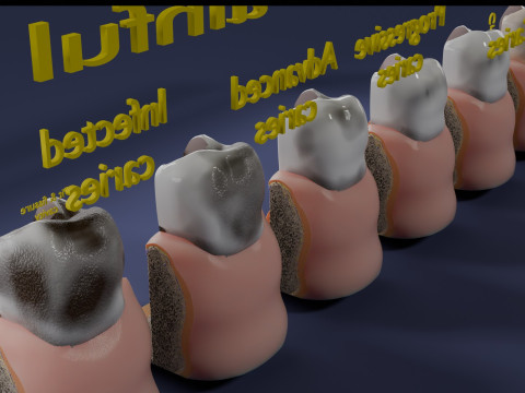Caries Teeth severity schematic cut sectional 3Dモデル
