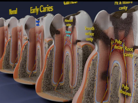 Caries Teeth severity schematic cut sectional 3D Model