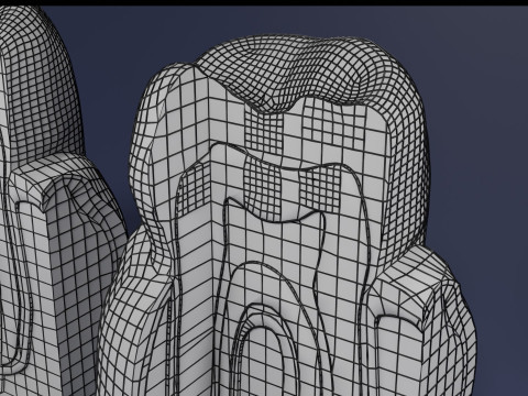 Caries Teeth severity schematic cut sectional 3Dモデル