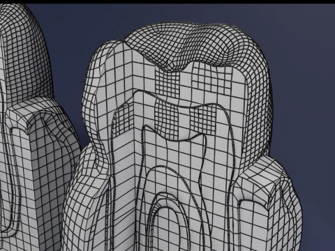 Caries Teeth severity schematic cut sectional 3D Model
