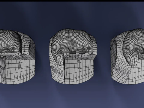 Caries Teeth severity schematic cut sectional 3D Model