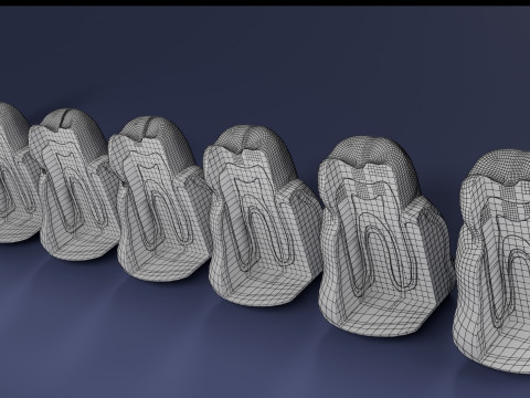 Caries Teeth severity schematic cut sectional 3Dモデル