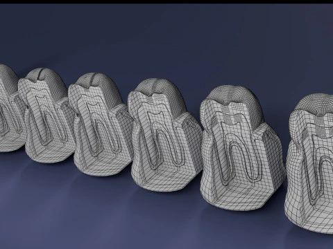 Caries Teeth severity schematic cut sectional 3D Model