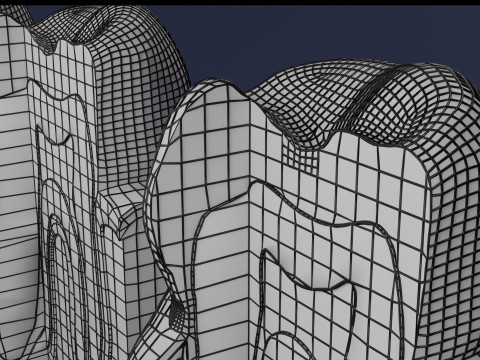 Caries Teeth severity schematic cut sectional 3Dモデル