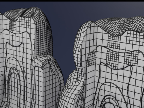 Caries Teeth severity schematic cut sectional 3Dモデル