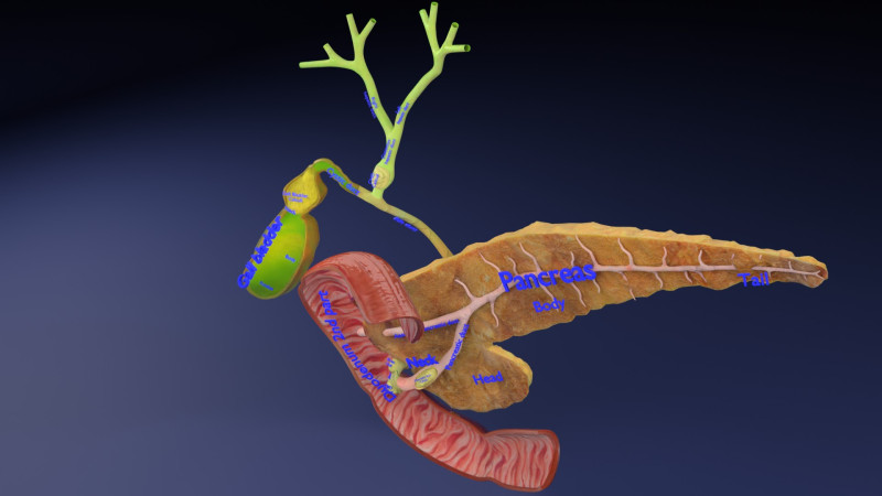 Biliary tract stone obstructions gallstone 3D 模型 .c4d .max .obj .3ds .fbx .stl .blend