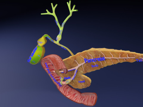 Biliary tract stone obstructions gallstone Model 3D