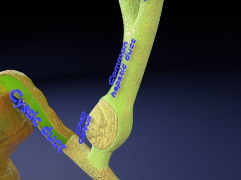 Biliary tract stone obstructions gallstone 3D 模型