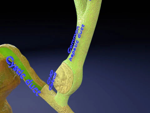 Biliary tract stone obstructions gallstone 3D Model