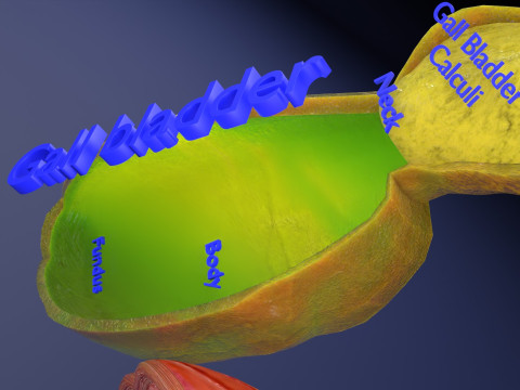 Biliary tract stone obstructions gallstone 3D 模型
