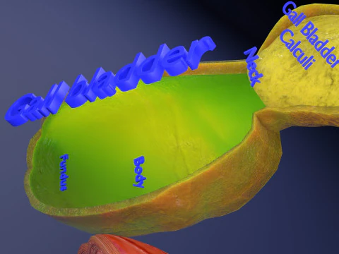 Biliary tract stone obstructions gallstone 3D Model