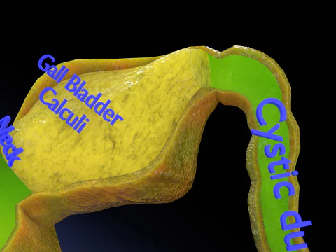 Biliary tract stone obstructions gallstone 3D Model