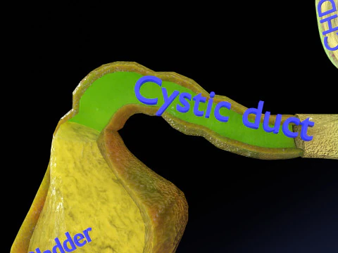 Biliary tract stone obstructions gallstone 3D Model