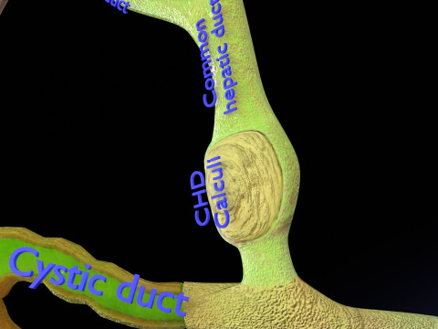 Biliary tract stone obstructions gallstone 3D 模型