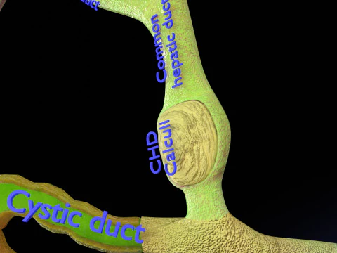 Biliary tract stone obstructions gallstone 3D Model