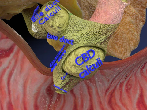 Biliary tract stone obstructions gallstone 3D Model