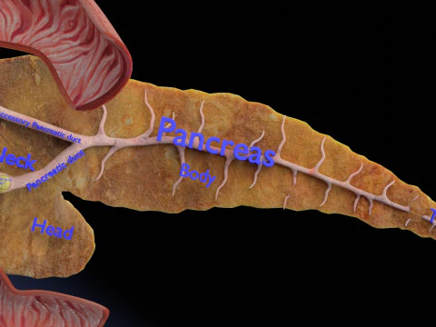 Biliary tract stone obstructions gallstone 3D Model