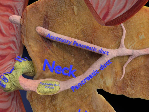 Biliary tract stone obstructions gallstone 3D Model