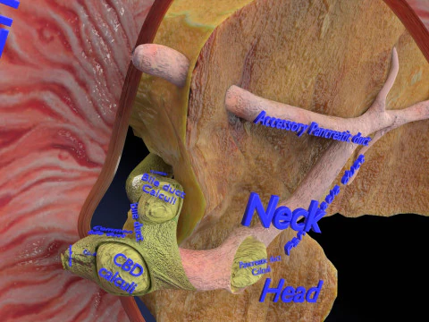 Biliary tract stone obstructions gallstone 3D Model