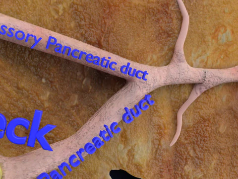 Biliary tract stone obstructions gallstone 3D Model