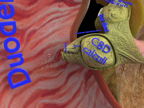 Biliary tract stone obstructions gallstone 3D 模型