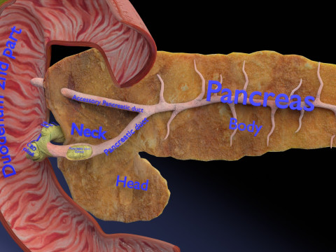 Biliary tract stone obstructions gallstone 3D 模型