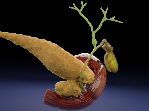 Biliary tract stone obstructions gallstone 3D 模型