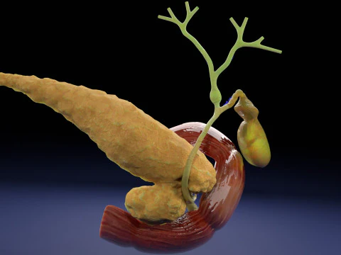 Biliary tract stone obstructions gallstone 3D Model