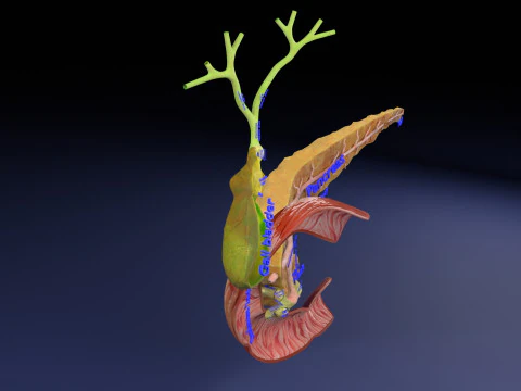 Biliary tract stone obstructions gallstone 3D Model