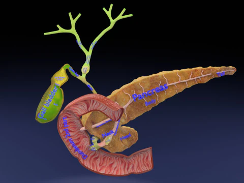 Biliary tract stone obstructions gallstone 3D Model