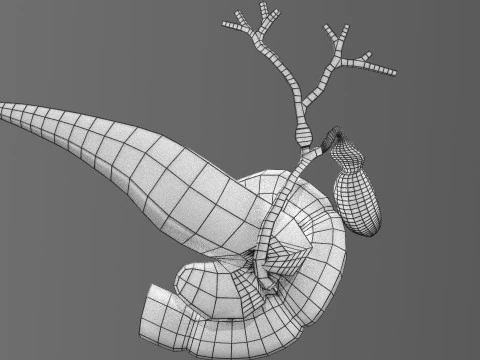 Biliary tract stone obstructions gallstone 3D Model