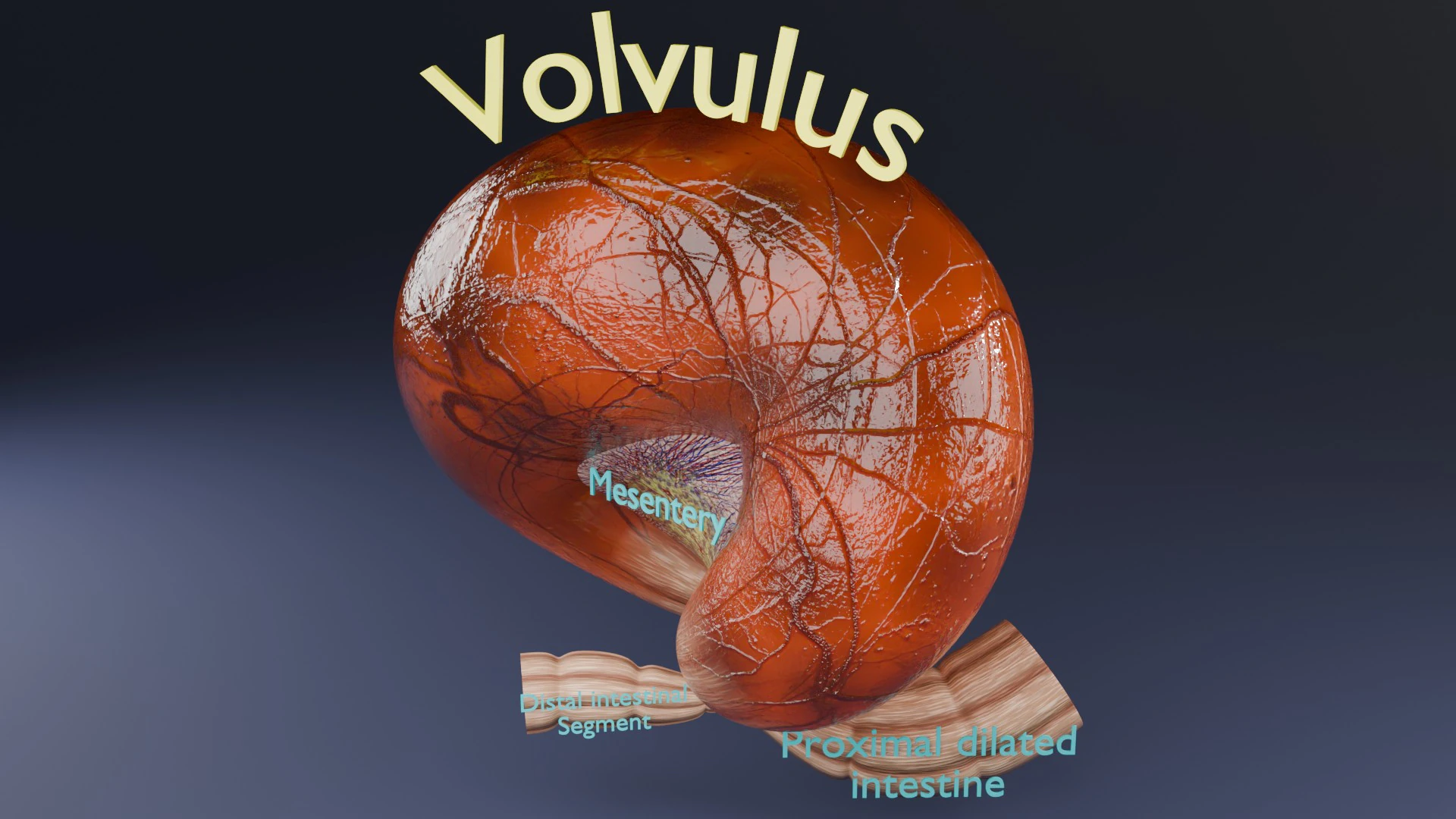 Volvulus intestine obstruction 3D Model .c4d .max .obj .3ds .fbx .stl .blend 