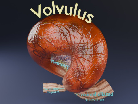 Volvulus intestine obstruction 3D Model